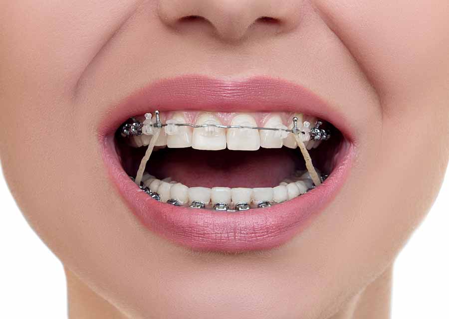 Invisalign