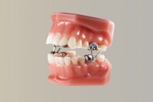 Why is a Herbst Appliance Recommended for an Overbite