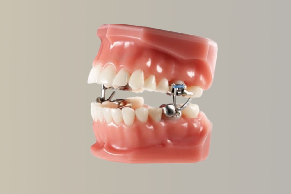 Why is a Herbst Appliance Recommended for an Overbite?